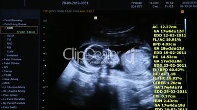 Ultrasound diagnosis of pregnant women baby in the belly