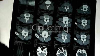 Doctors study skull brain X-ray film for analysis.cerebellum,brainstem.