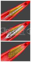 Angioplasty