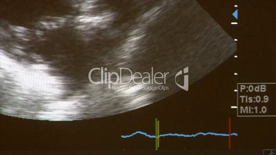 ultrasound scan of human heart