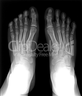 Foot fingers exposed on x-ray black and white film, MRI