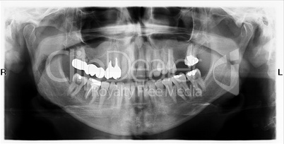 Teeth on X-Ray Image
