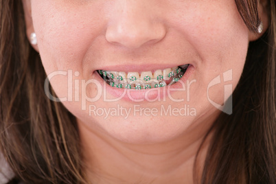 Close-up of a smiling young teenager with braces