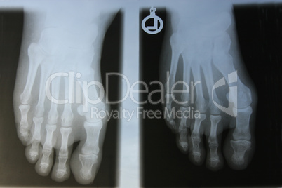 Radiographie Hallux valgus