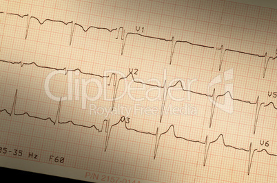 Closeup of electrocardiogram EKG printout
