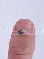 Subungual hematoma under nail