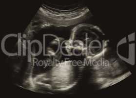 Obstetric Ultrasonography Ultrasound Echography of a first month