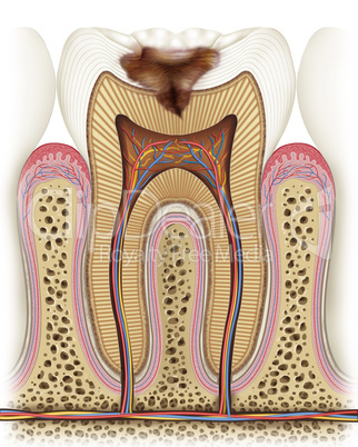 Carié undergoing degeneration