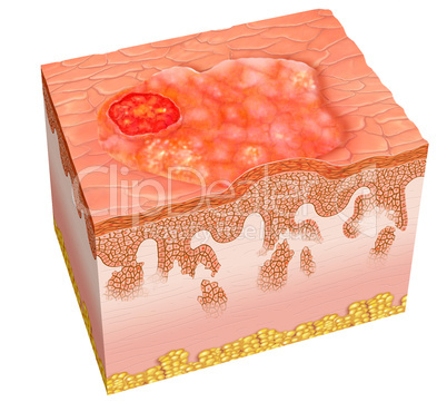 squamous cell carcinoma