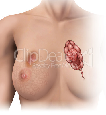 Tumor in the breast lobules