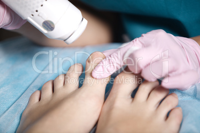 woman receiving laser treatment on her feet