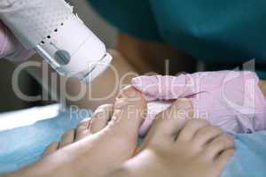 podiatrist treating onychomycosis with a laser