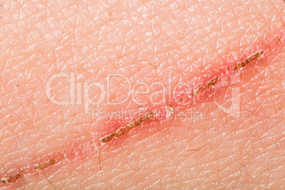 texture of human skin and scratch