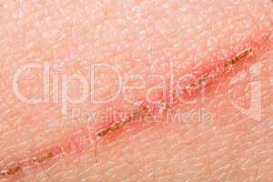 texture of human skin and scratch