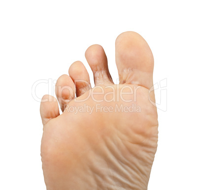 Athlete's foot,  Tinea pedis