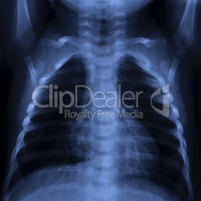 thorax x ray