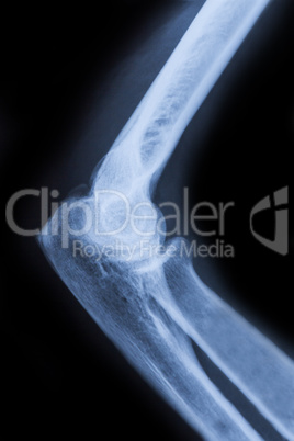 elbow x ray