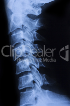 spine x ray