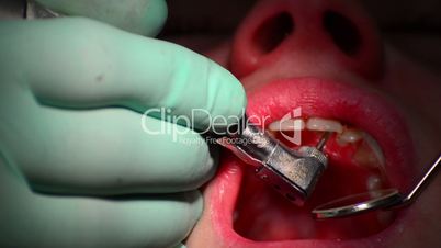 dental drill is driling caries from teeth close up