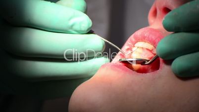 dentist check gum for gingivitis desease