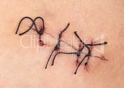 Wound with surgical stitch