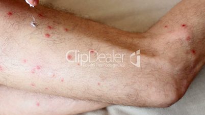 Allergy on legs