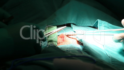 Close up of a suture in a surgery