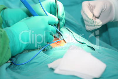 Doctor using an electronic scalpel in a surgery