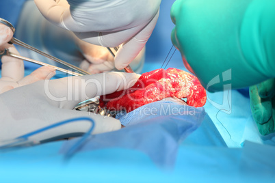 Suture of an lung emphysema surgery in an infant