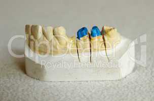 Zirconium or porcelain crown preparation