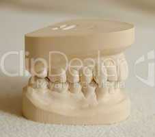 Dental gypsum model mould of teeth