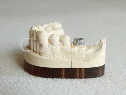 Zirconium or porcelain crown preparation