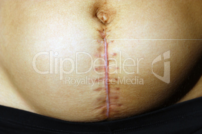 seams after the operation of Caesarian section