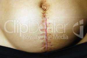 seams after the operation of Caesarian section