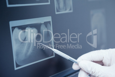 Gloved hand holding dental tool to teeth x-ray