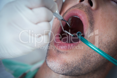 Close up of man having his teeth examined