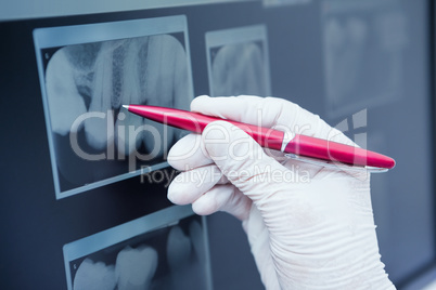 Gloved hand holding pen to teeth x-ray