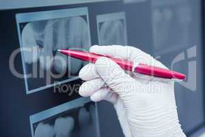 Gloved hand holding pen to teeth x-ray
