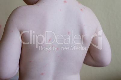 Chickenpox disease