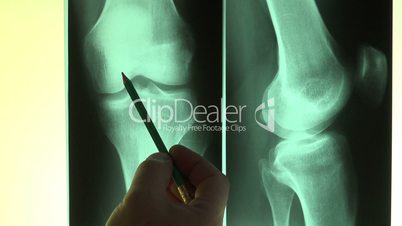 Doctor reading X-Rays pointing with a pencil - Full HD