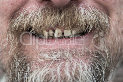 Man with tobacco stained teeth