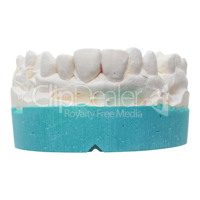 Positive teeth cast