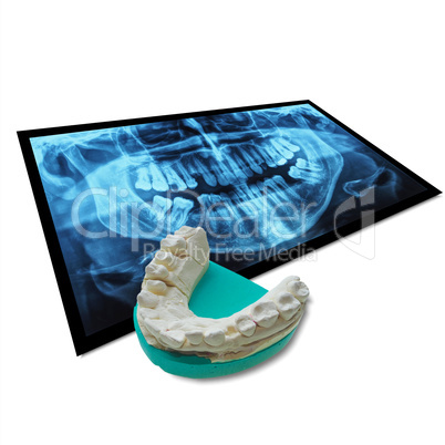 Xray of teeth with positive teeth cast