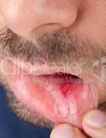 Man shows his lower lip with aphtha