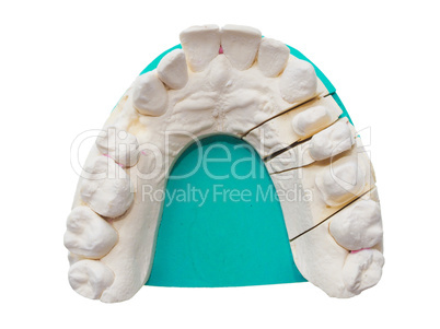 Positive teeth cast