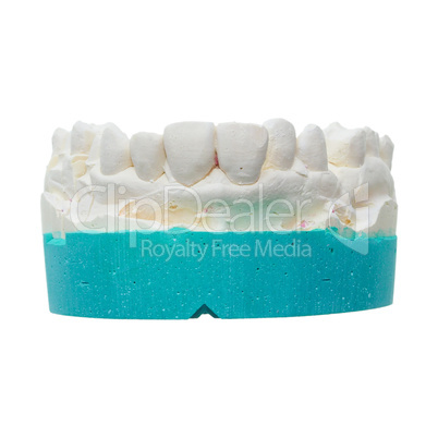 Positive teeth cast