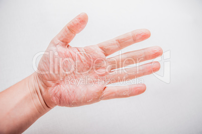 The problem with many people - eczema on hand. Isolated background