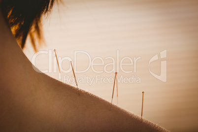 Young woman getting acupuncture treatment