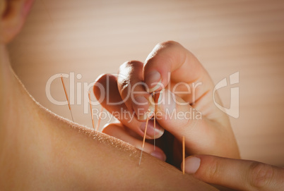 Young woman getting acupuncture treatment