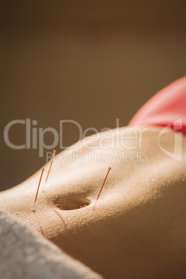 Young woman getting acupuncture treatment